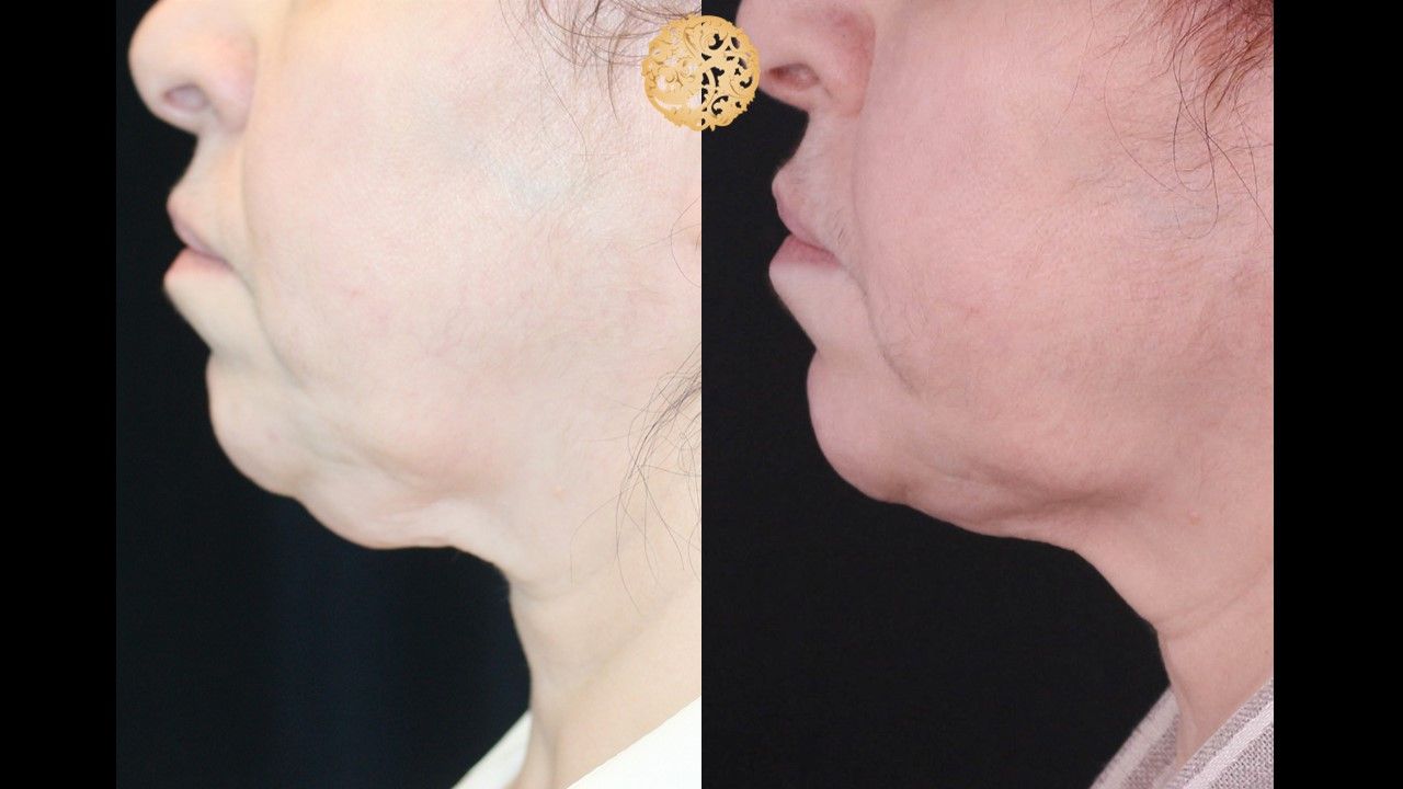 Face Liposuction Before & After