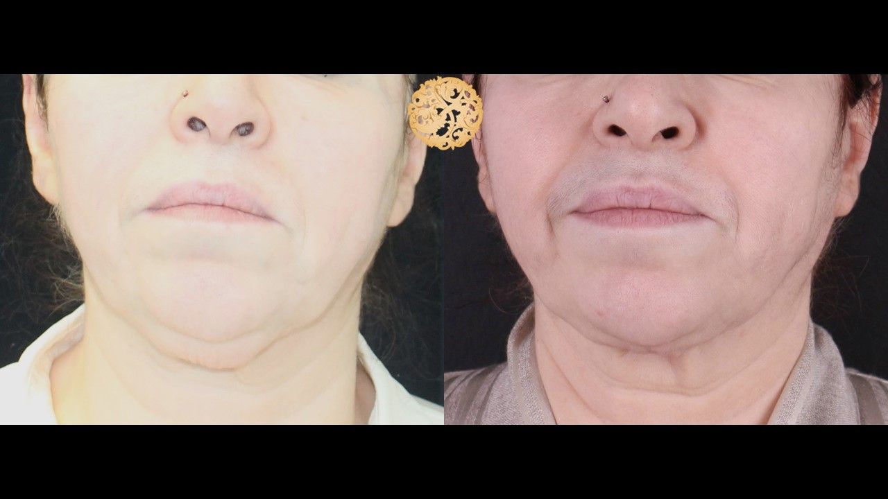 Face Liposuction Before & After