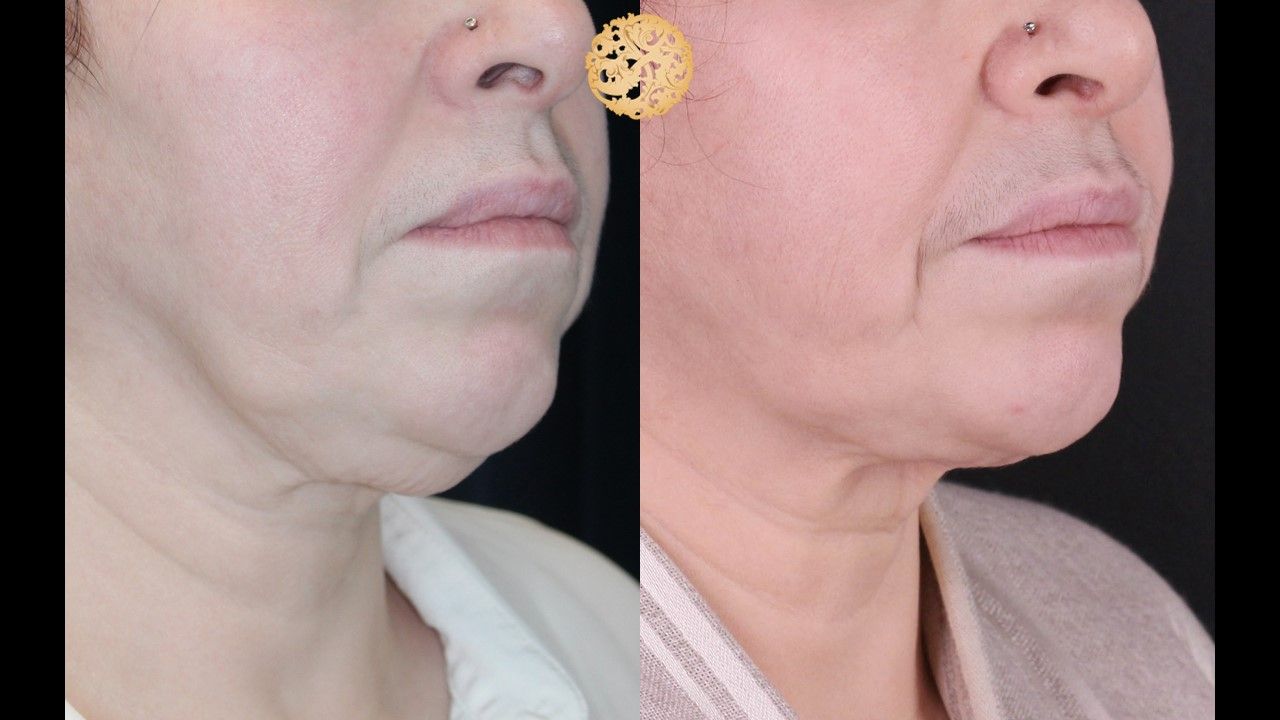 Face Liposuction Before & After