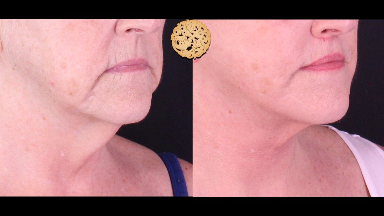 Face Liposuction Before & After