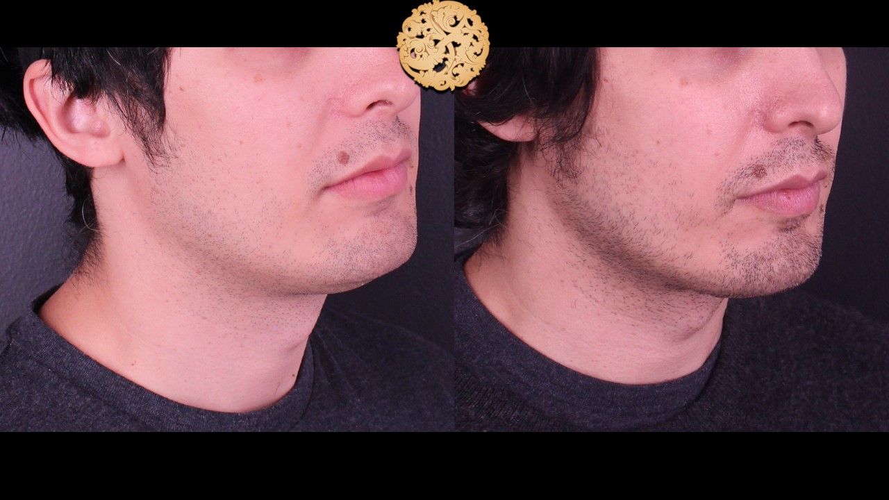 Face Liposuction Before & After