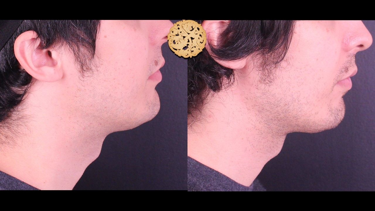 Face Liposuction Before & After