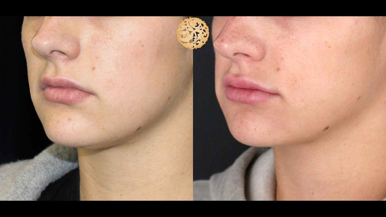 Face Liposuction Before & After