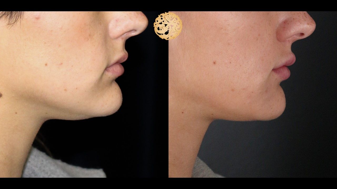Face Liposuction Before & After