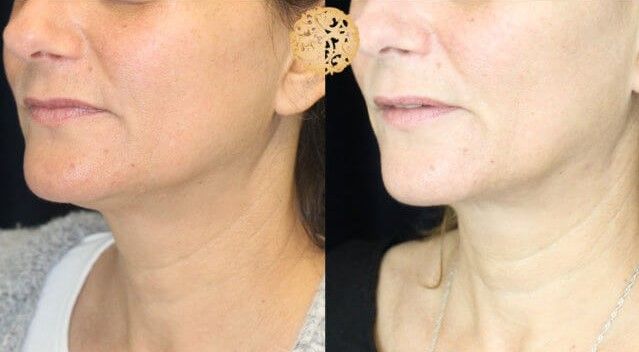 Face Liposuction Before & After
