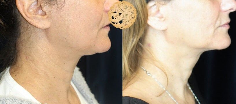 Face Liposuction Before & After
