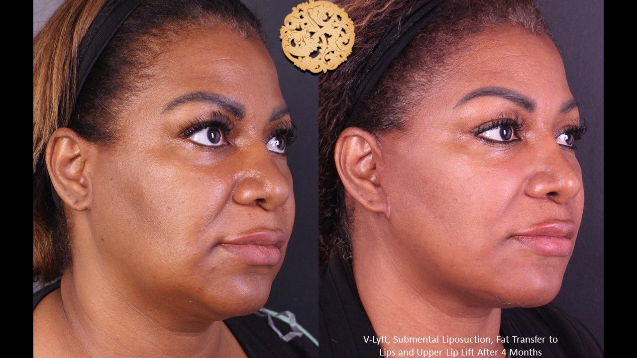Face Liposuction Before & After