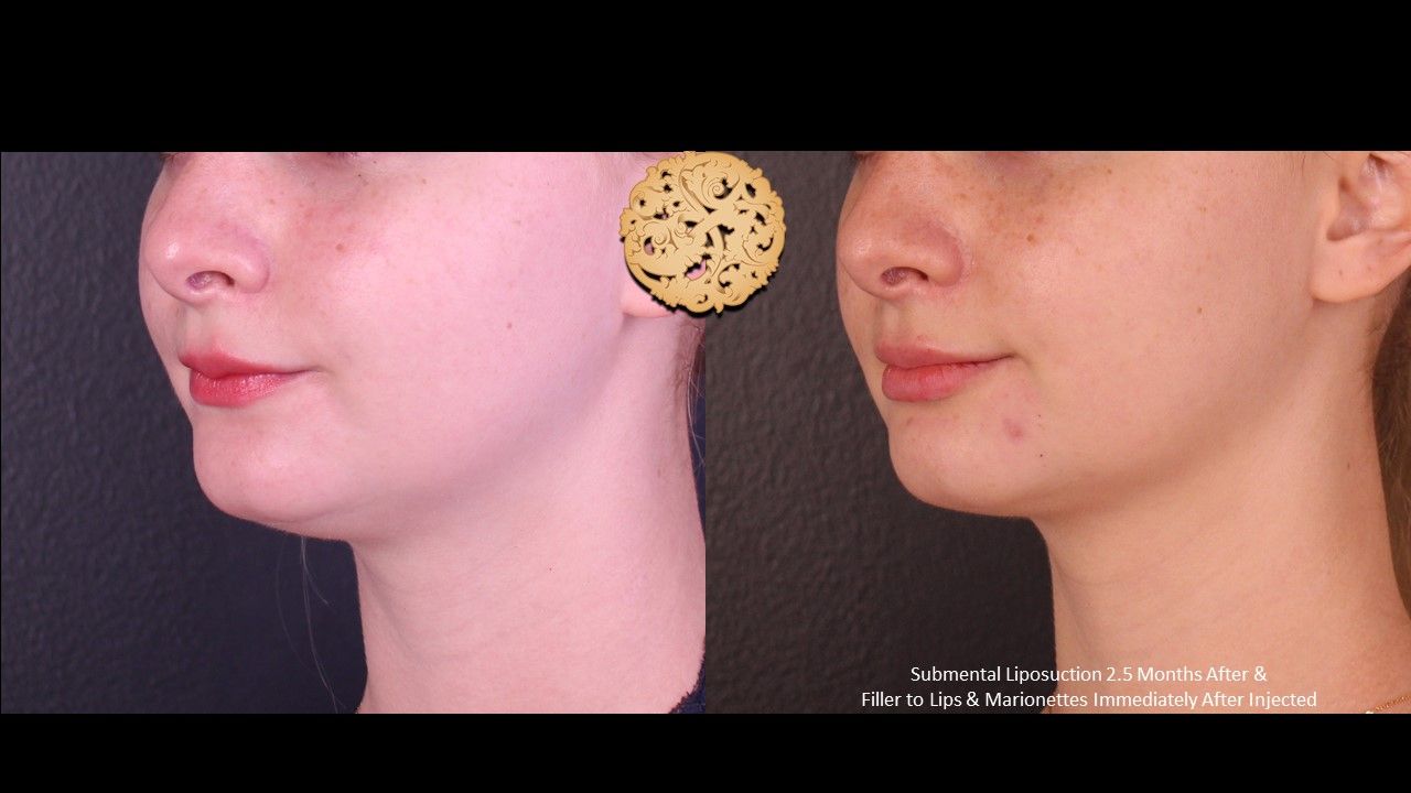 Face Liposuction Before & After
