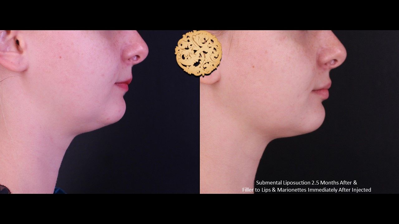 Face Liposuction Before & After