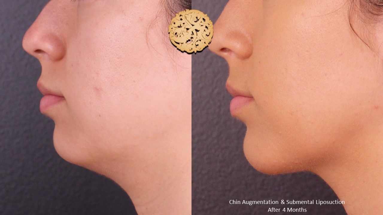 Face Liposuction Before & After