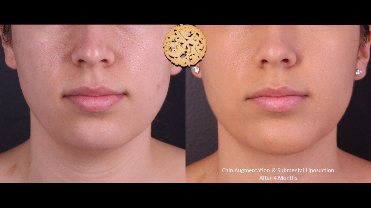Face Liposuction Before & After