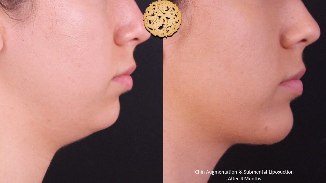 Face Liposuction Before & After
