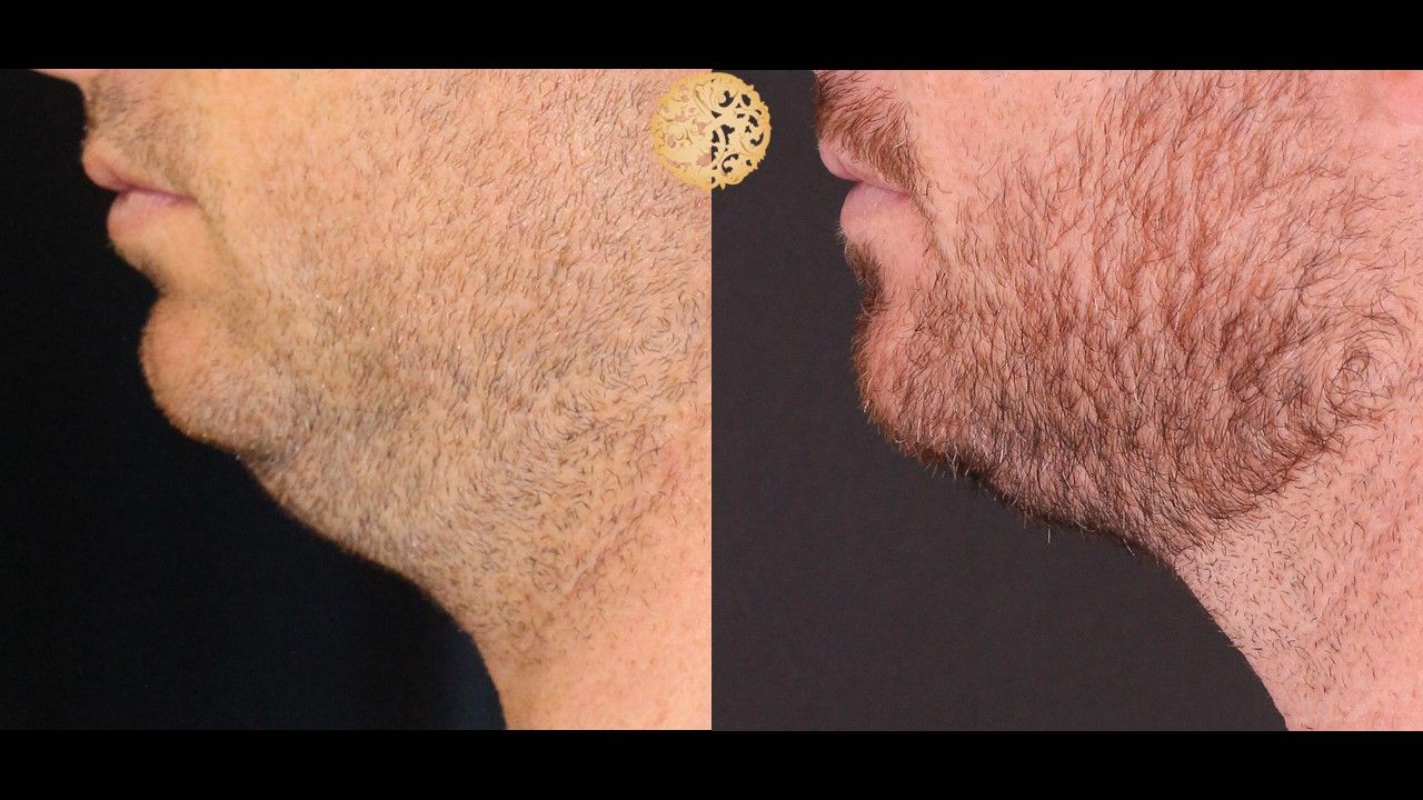 Face Liposuction Before & After