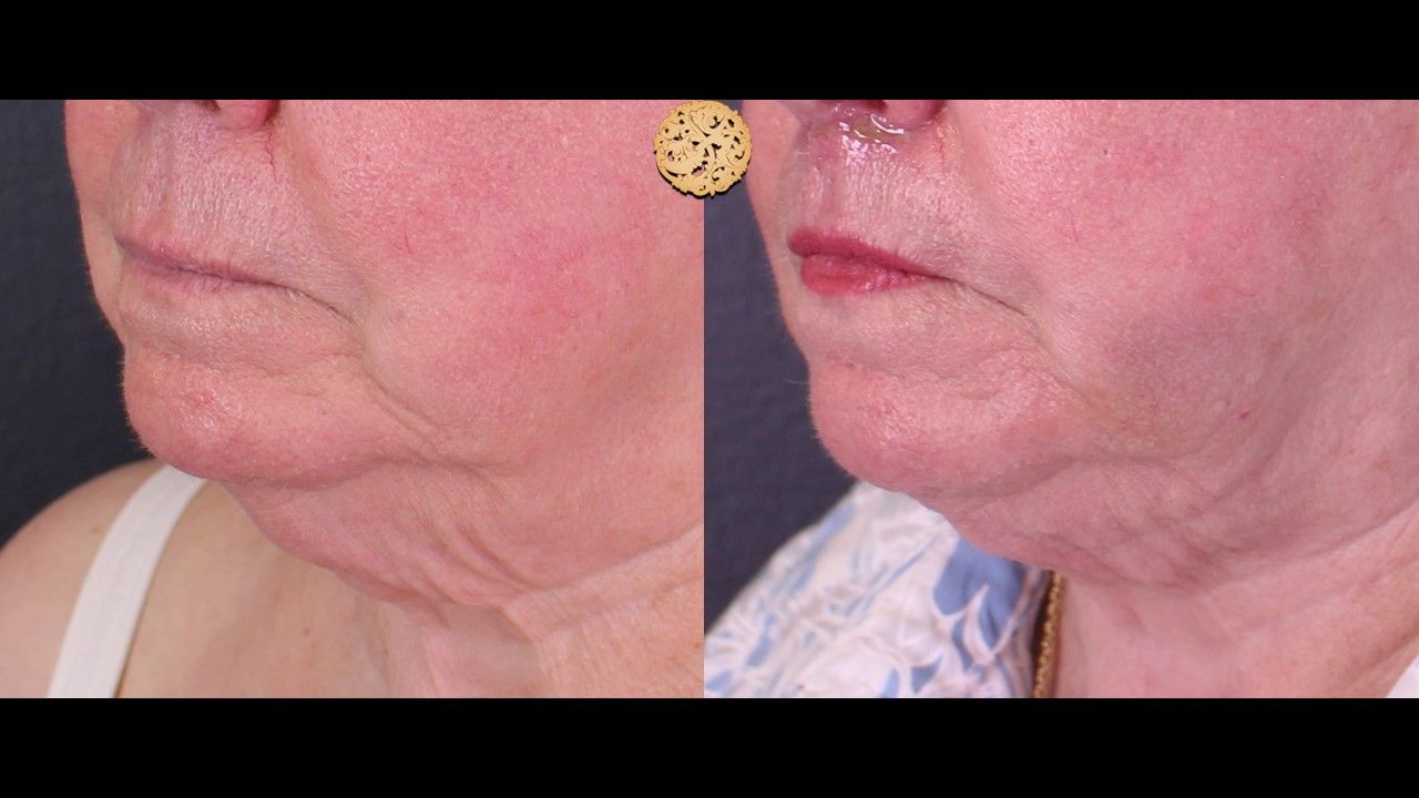 Face Liposuction Before & After