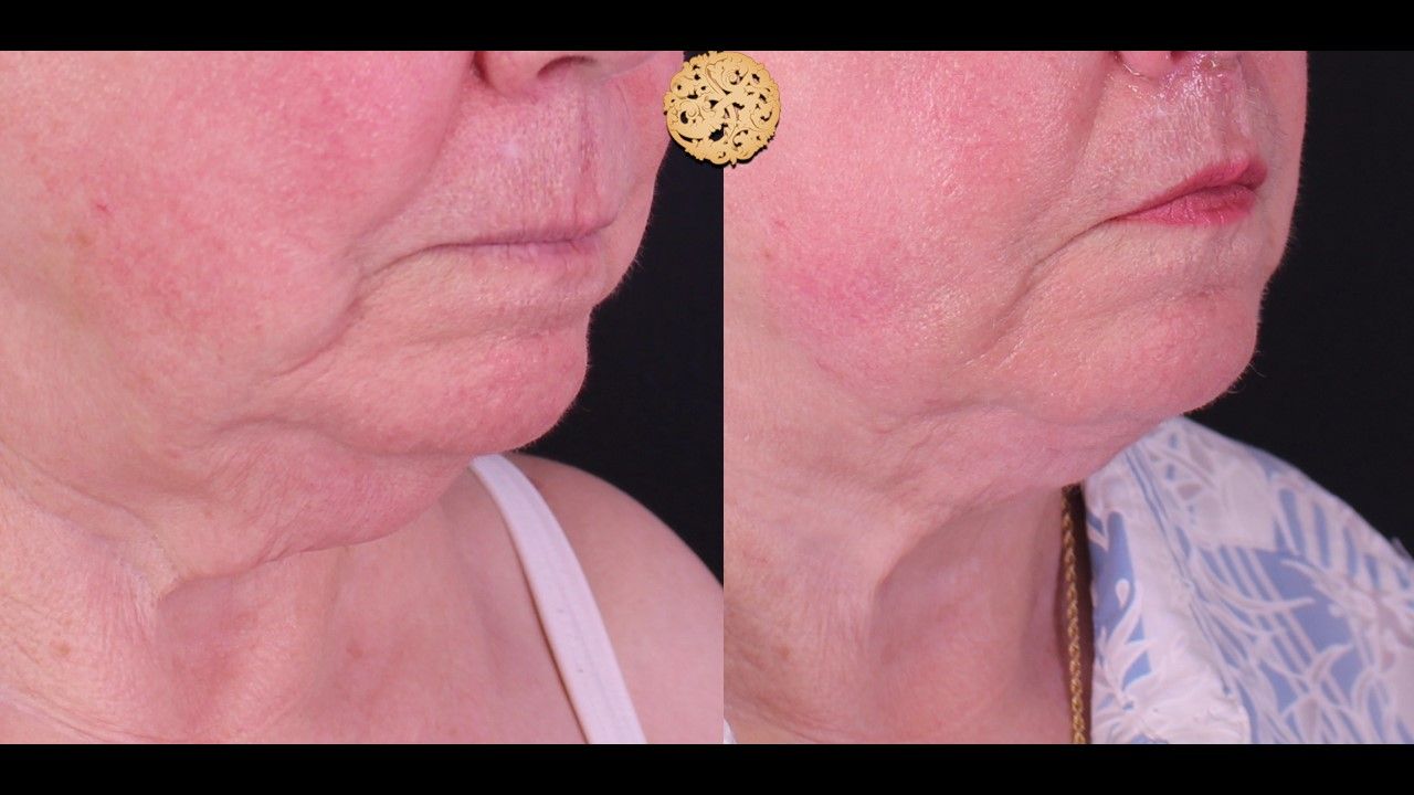 Face Liposuction Before & After