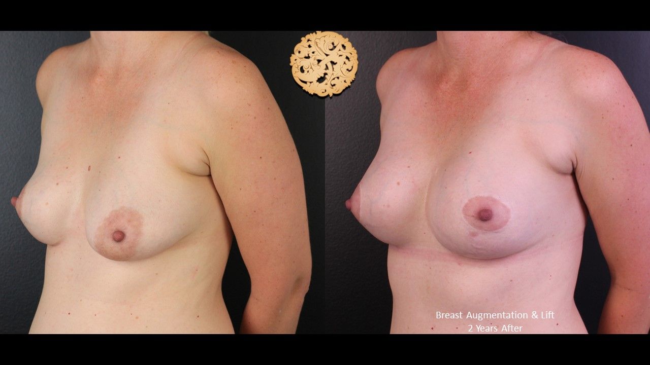 Breast Augmentation With Lift Before & After