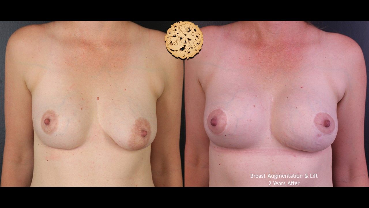 Breast Augmentation With Lift Before & After