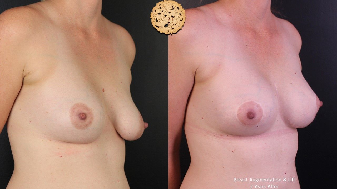 Breast Augmentation With Lift Before & After