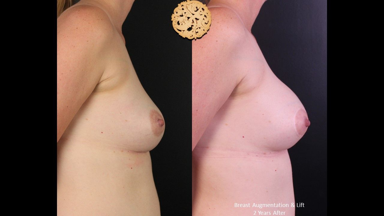 Breast Augmentation With Lift Before & After