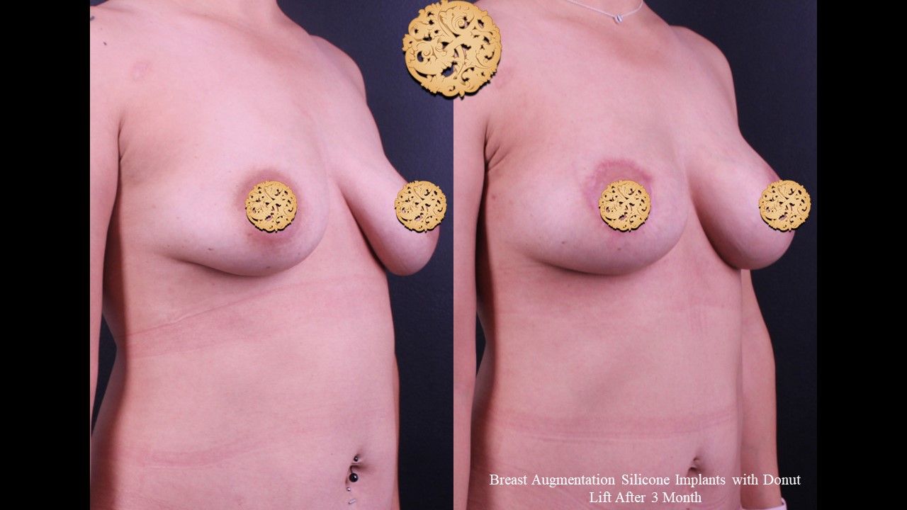 Breast Augmentation With Lift Before & After