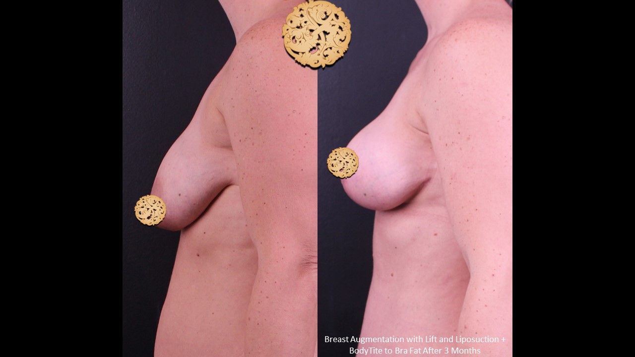 Breast Augmentation With Lift Before & After