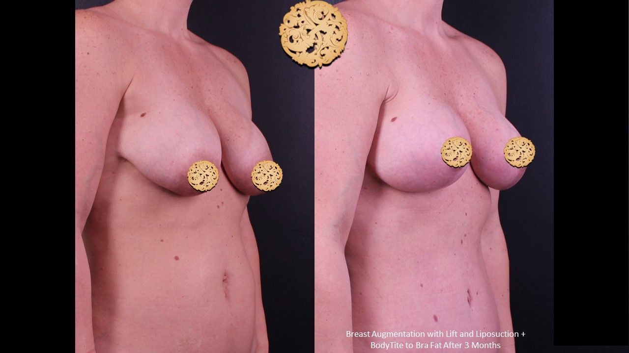 Breast Augmentation With Lift Before & After