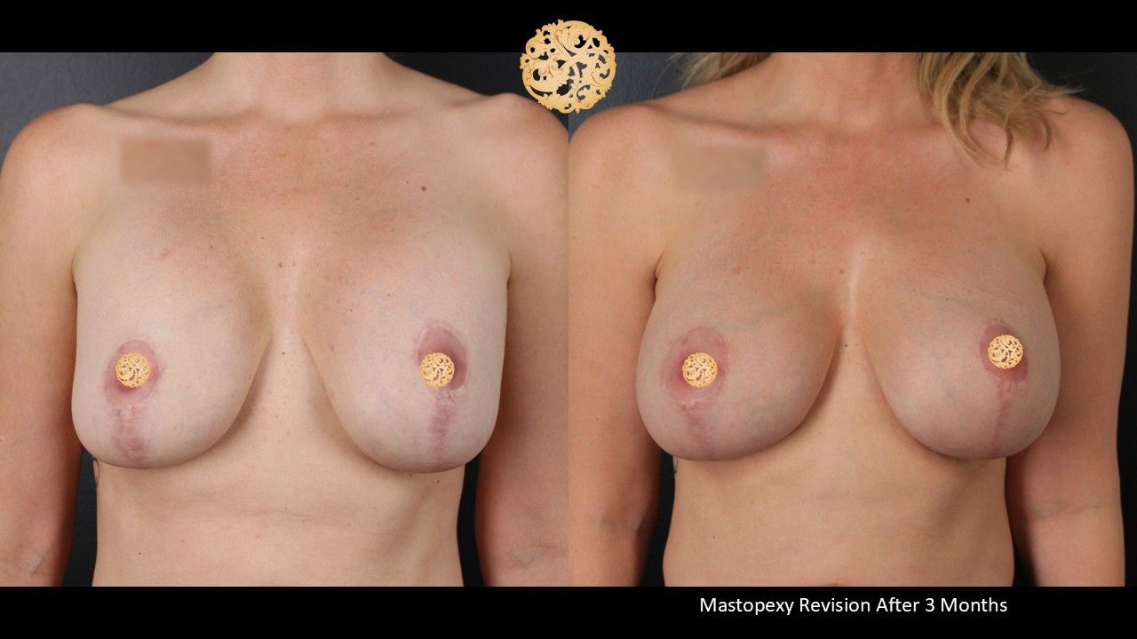 Breast Augmentation With Lift Before & After
