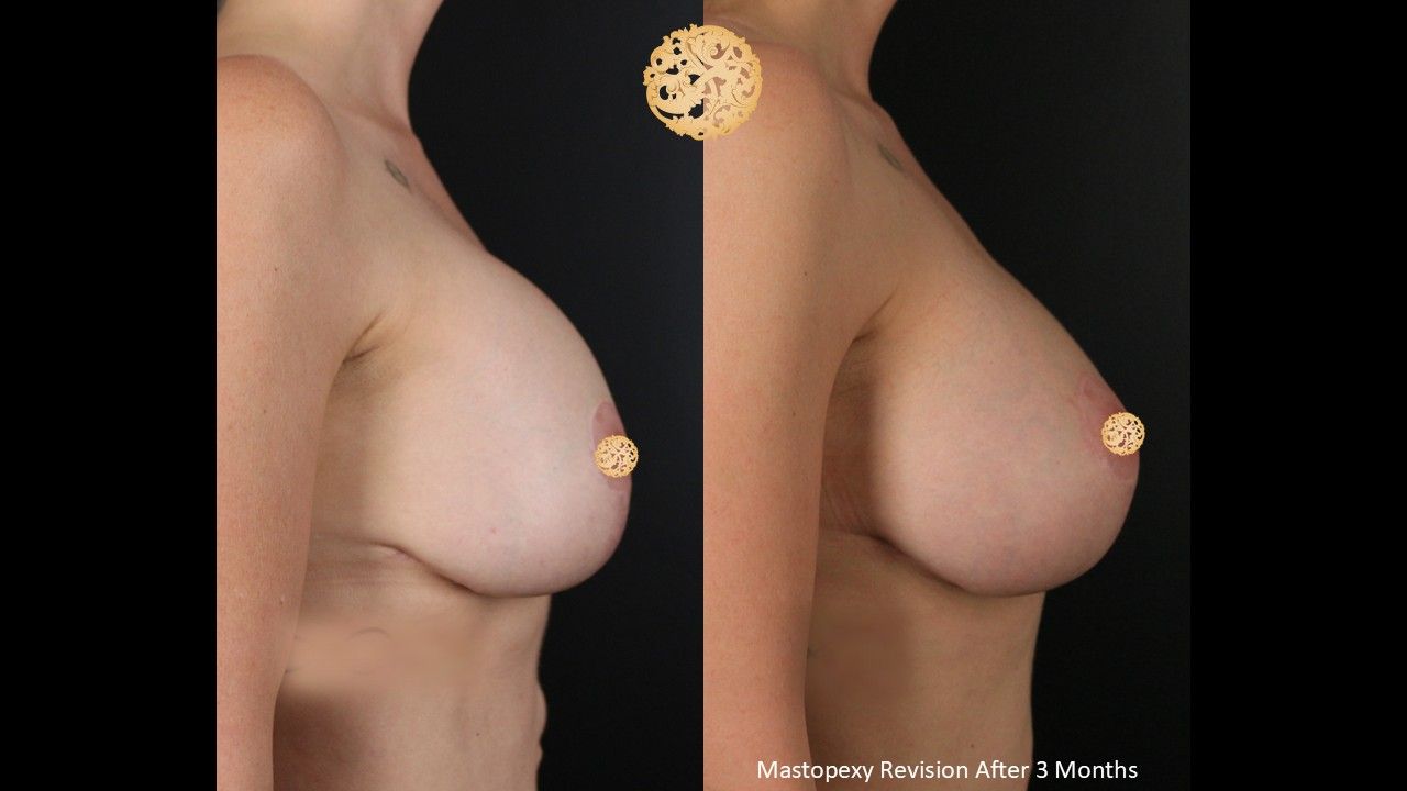 Breast Augmentation With Lift Before & After