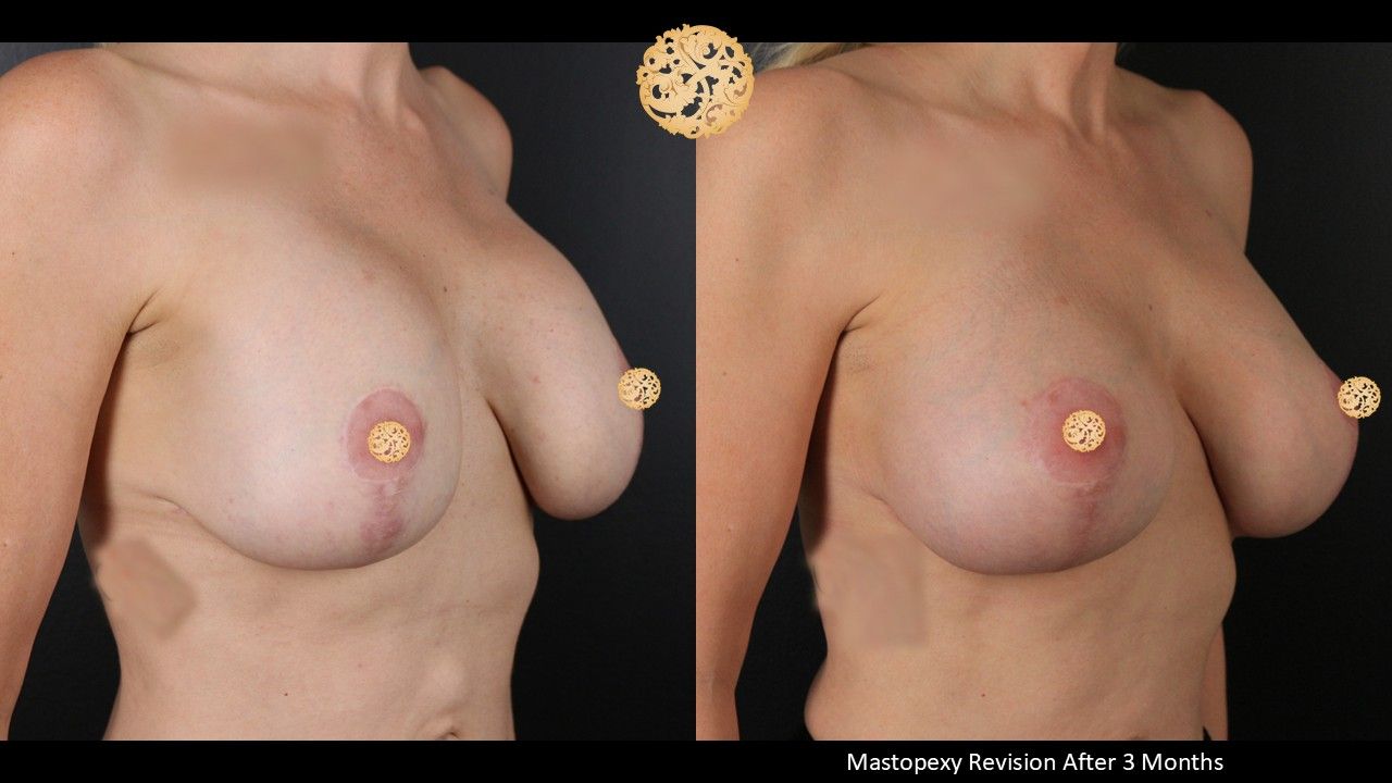 Breast Augmentation With Lift Before & After