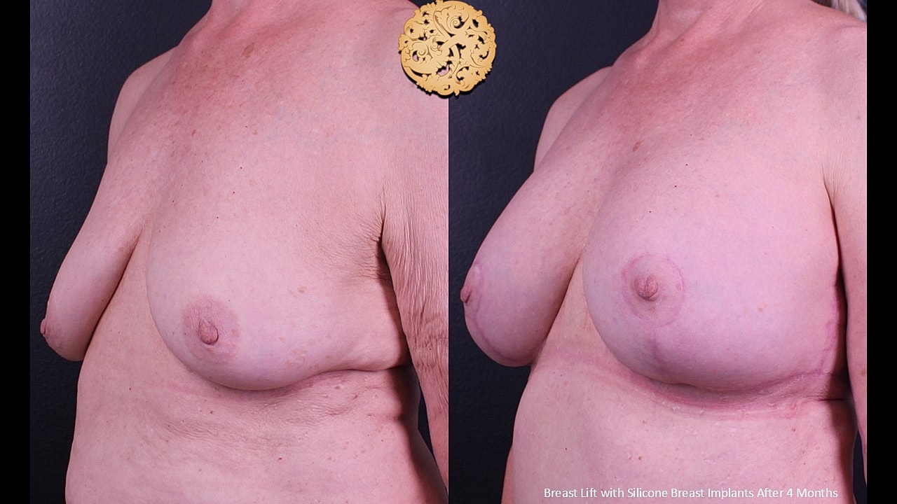 Breast Augmentation With Lift Before & After