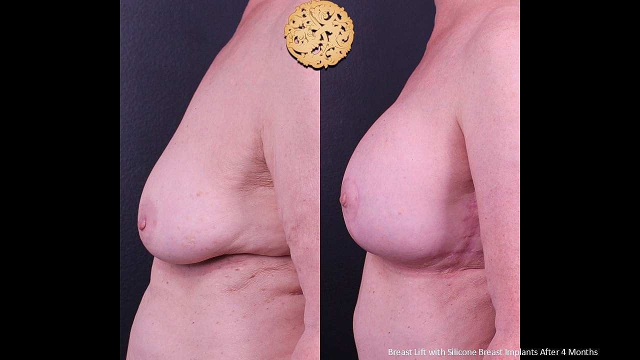 Breast Augmentation With Lift Before & After