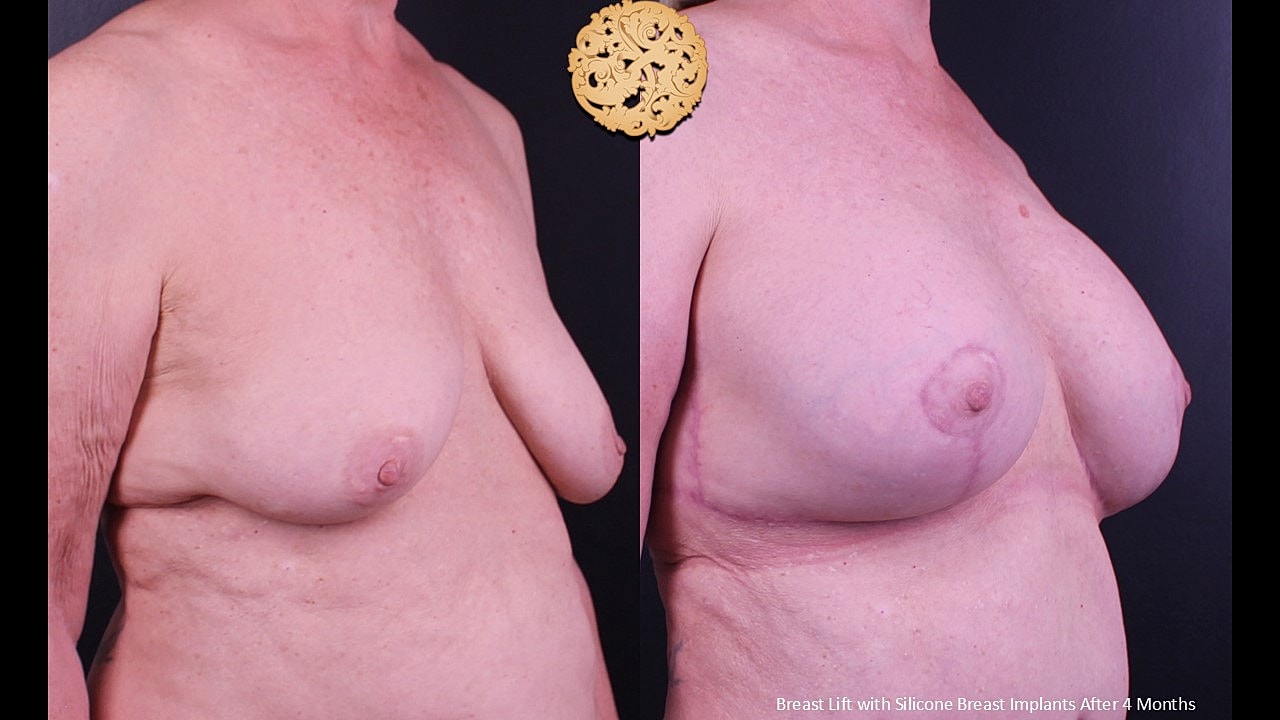 Breast Augmentation With Lift Before & After