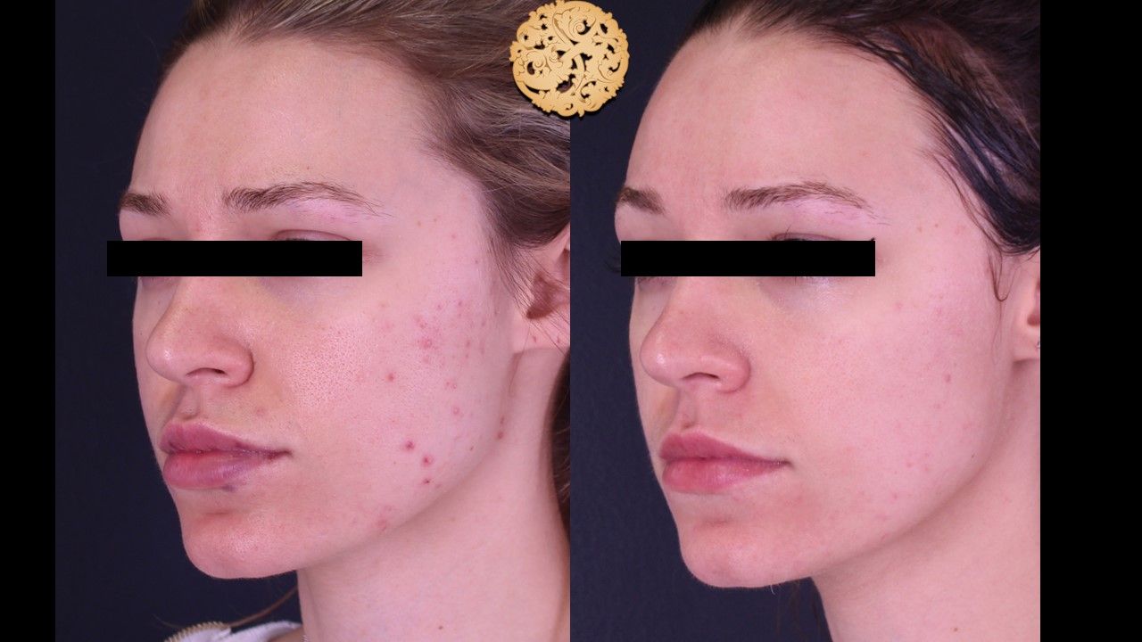 Acne Before & After