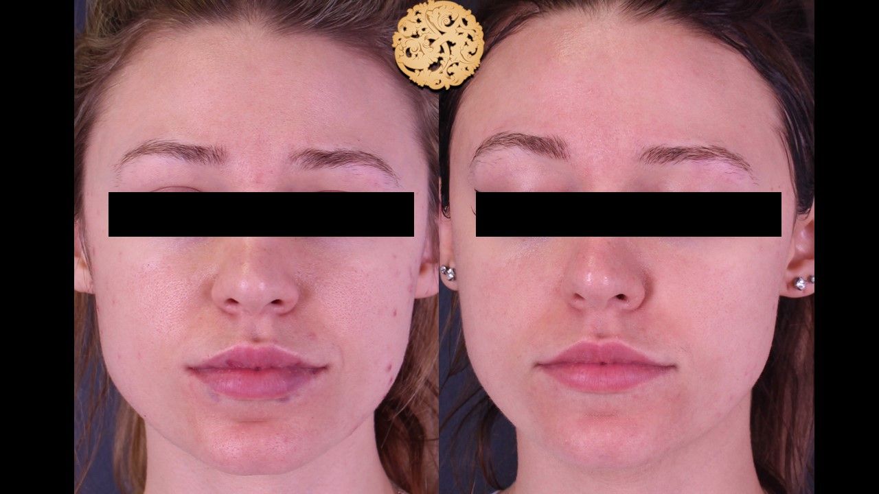 Acne Before & After