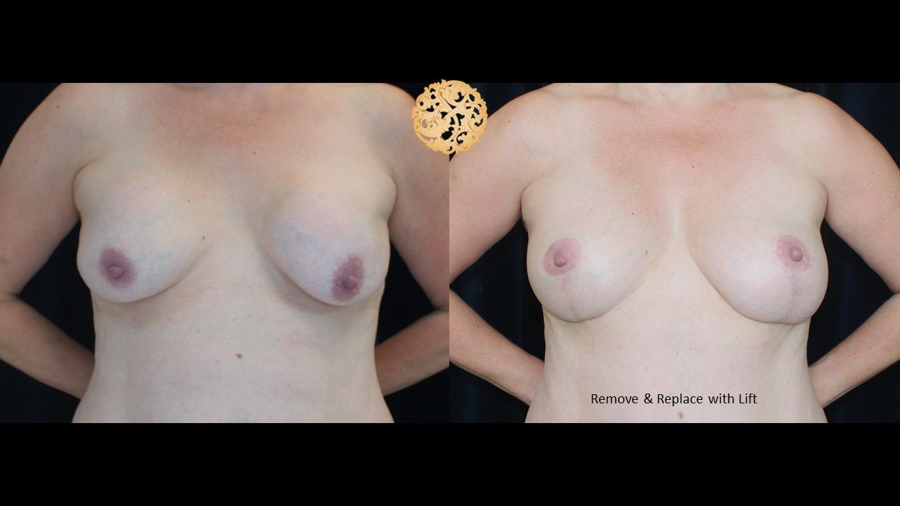 Breast Revision Before & After