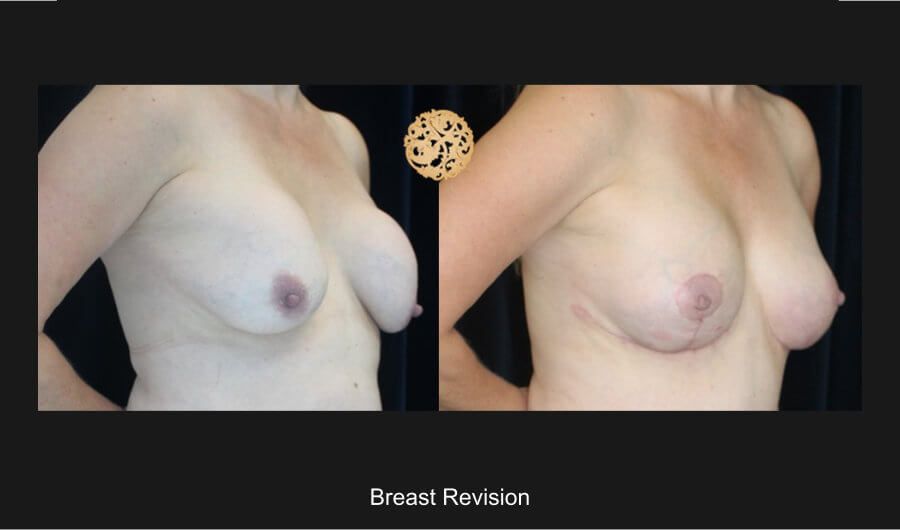 Breast Revision Before & After