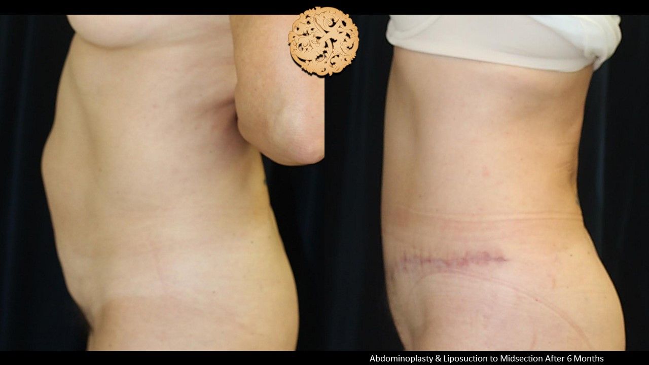 Tummy Tuck Before & After