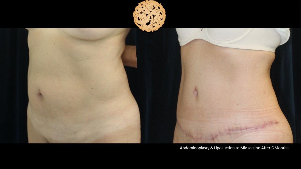 Tummy Tuck Before & After