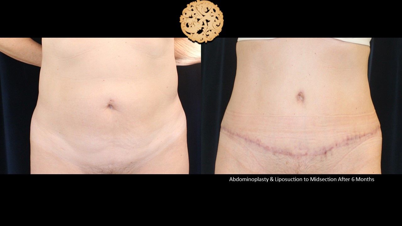Tummy Tuck Before & After