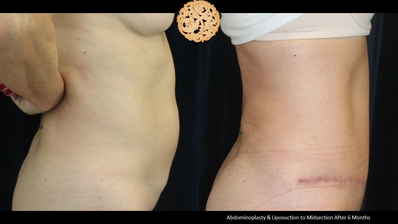 Tummy Tuck Before & After