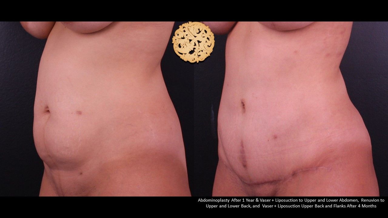 Tummy Tuck Before & After