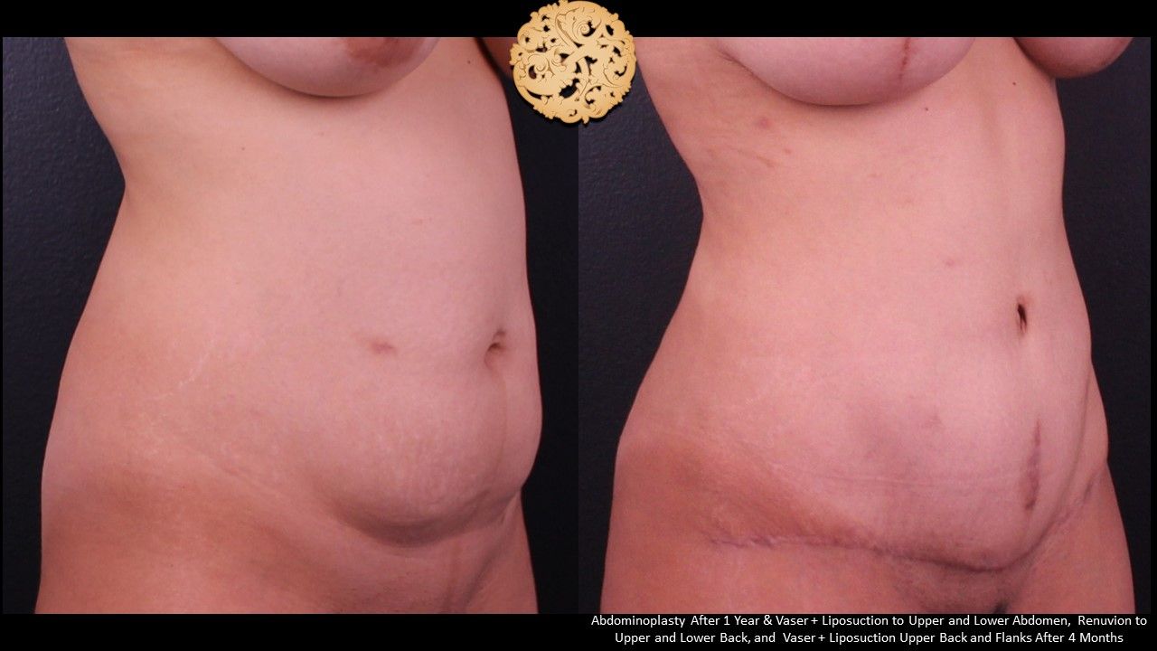 Tummy Tuck Before & After