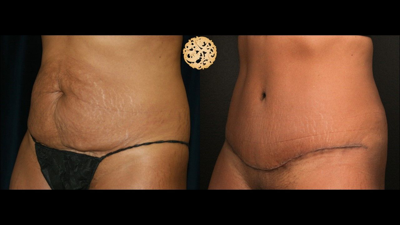 Tummy Tuck Before & After