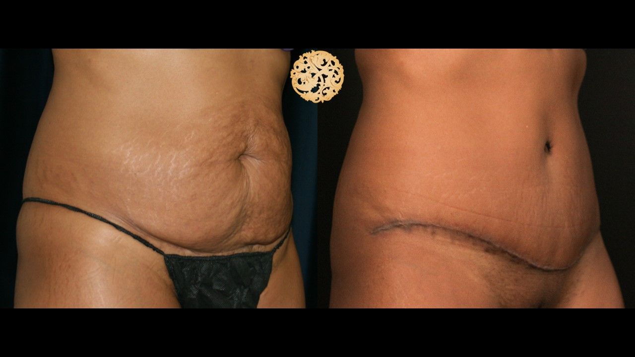 Tummy Tuck Before & After