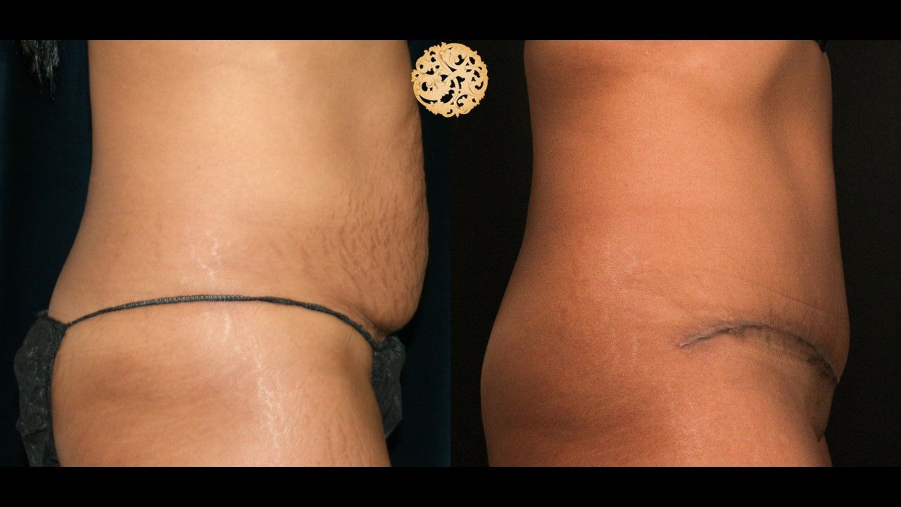 Tummy Tuck Before & After
