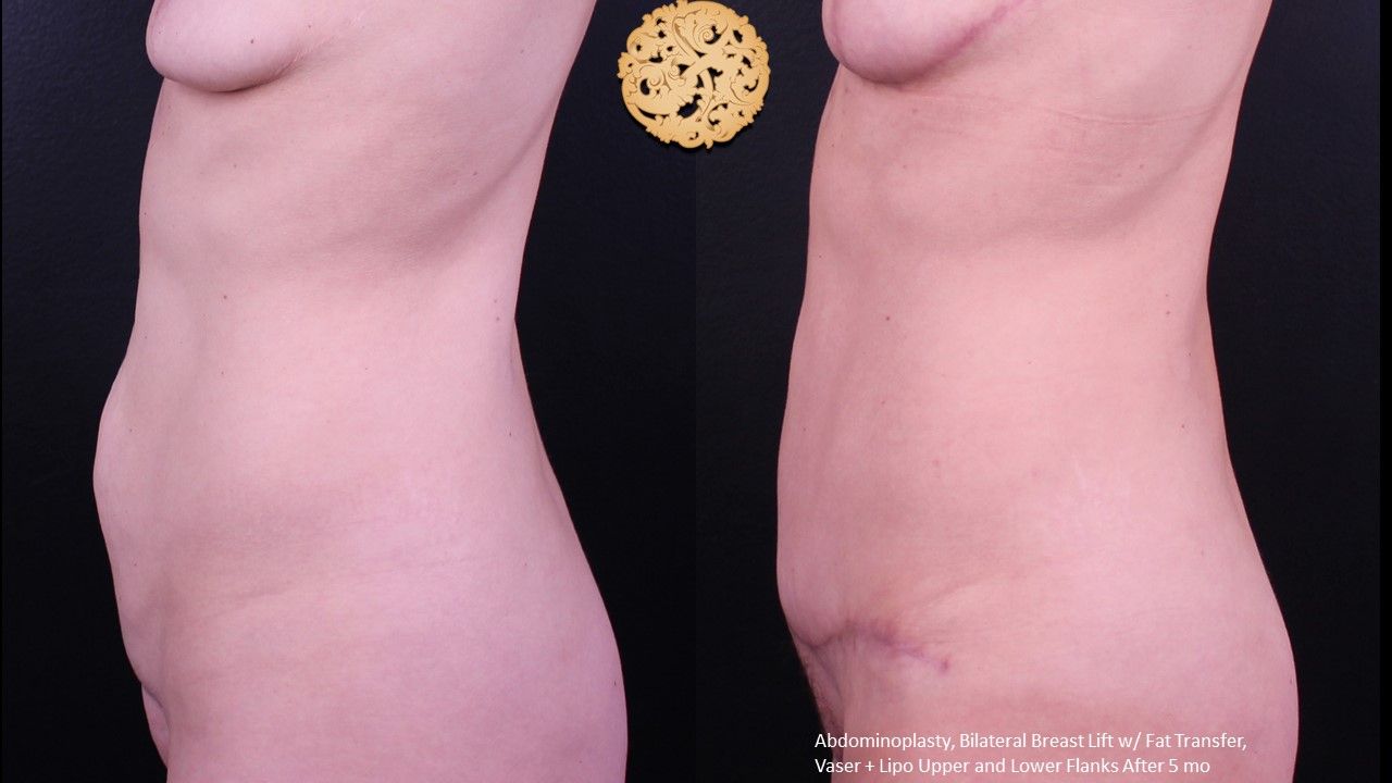 Tummy Tuck Before & After