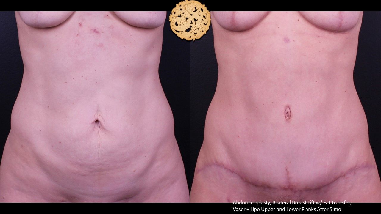 Tummy Tuck Before & After