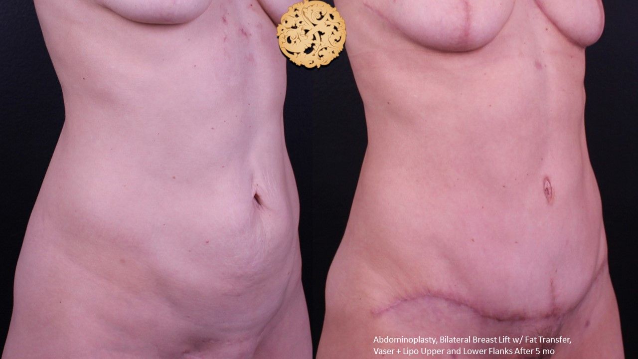 Tummy Tuck Before & After