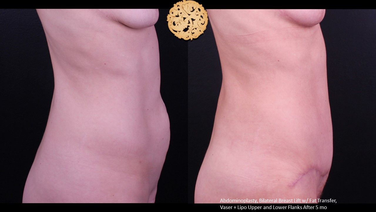 Tummy Tuck Before & After