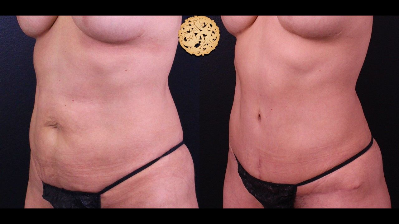 Tummy Tuck Before & After